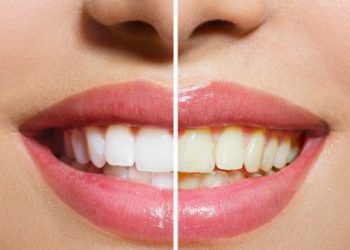 Teeth Whitening: Get Your Brightest Smile for the Holidays